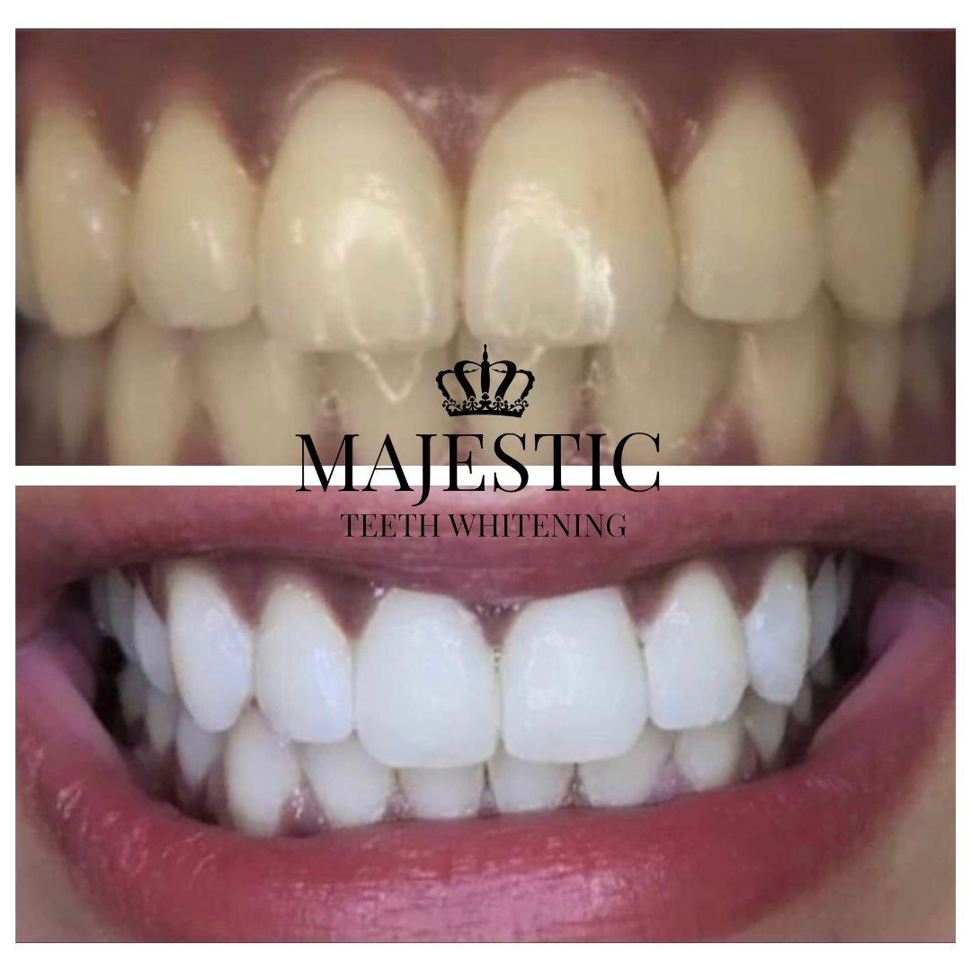 Majestic Teeth Whitening